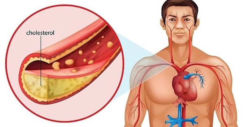 Người có cholesterol cao, bệnh tim mạch, đang kiểm soát cân nặng, cần hạn chế natri hoặc có tiền sử dị ứng với trứng nên thận trọng hơn khi ăn trứng vịt lộn.