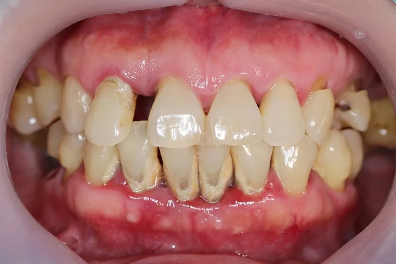 Mảng bám và cao răng tích tụ lâu ngày là nguyên nhân hàng đầu gây ra tình trạng viêm nướu.