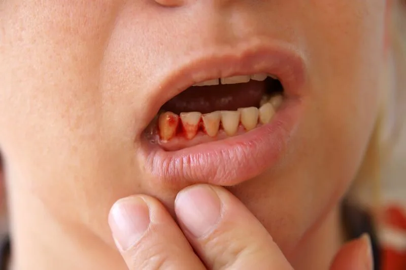 Chảy máu chân răng là dấu hiệu cảnh báo mô nướu đang bị tổn thương hoặc viêm nhiễm.